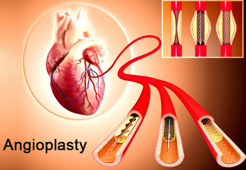 Coronary Angioplasty