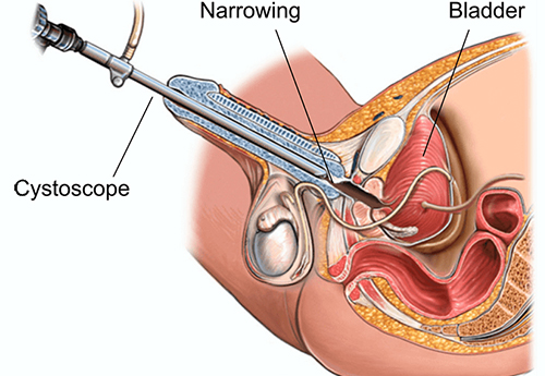 OIU (For Urethral Structure)