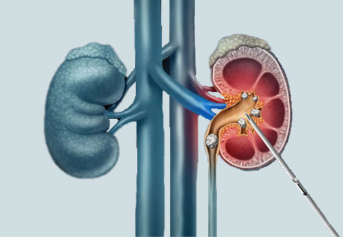 PCNL (Percutaneous Nephrolithotomy)