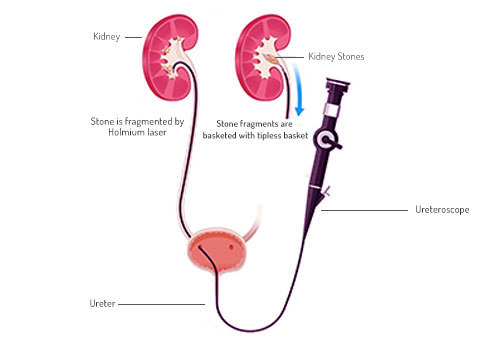 RIRS (Retrograde Intrarenal Surgery) - KIDNEY Stone