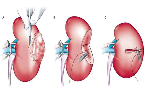 PCNL (Percutaneous Nephrolithotomy)