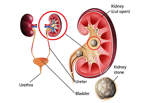 URS (Ureteric stone)